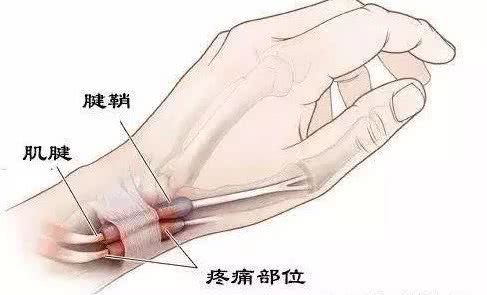 之所以感觉封闭治疗效果不好,症状容易复发,是因为封闭针里有麻醉药