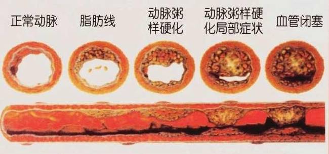 动脉粥样硬化斑块会提前出现哪些症状 第一种胸闷疼痛