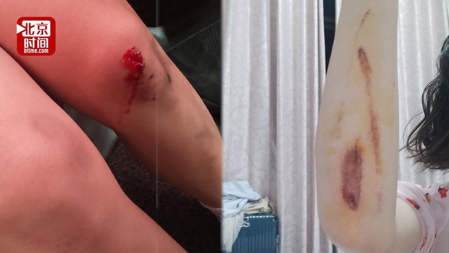 女孩骑共享电瓶车摔伤索赔100元遭拒 客服:索赔金额过低走不了流程 女孩骑共享电瓶车摔伤索赔100元遭拒 客服:索赔金额过低走不了流程