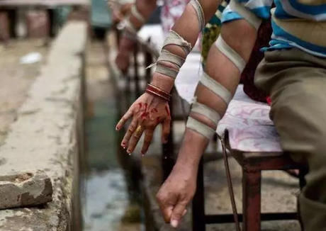 中医说放血能治病,却不会告诉你治死了多少人