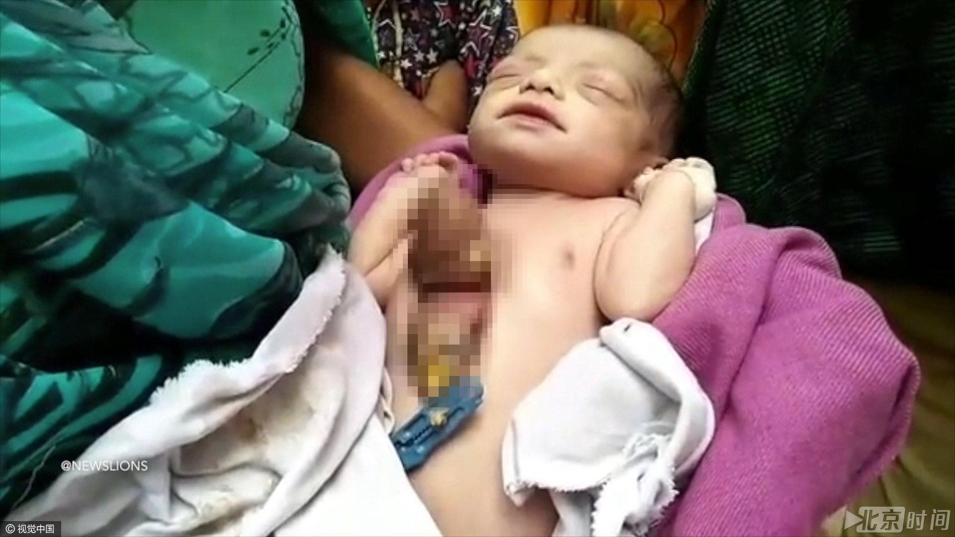 当地儿童医院的专家表示：“心脏是有人体的骨骼和皮肤包裹着的，虽然宝宝的心脏还在发育期间，这个病例也非常罕见，只要经过手术，还是能够挽救的。”