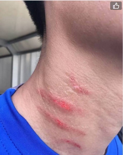 组图-九阴白骨爪!中乙球员赛后脖子被抓4道血痕