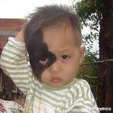 怀孕期间吃错水果容易诱发胎儿出生脸上长胎记