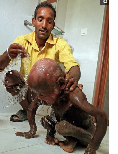 印度小孩皮肤硬化脱落变石头人,村民怕被传染