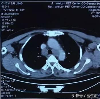 PET-CT提示肺癌多发转移,多次活检阴性的患者
