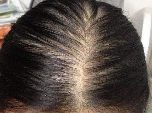 头发油、脱发断发是头皮衰老的信号,3方法头发