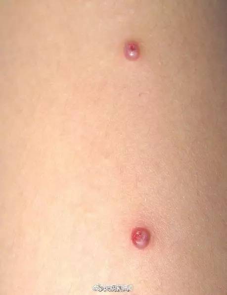 女孩头皮出现黑点,上面还有腿!家长看了吓了一大跳