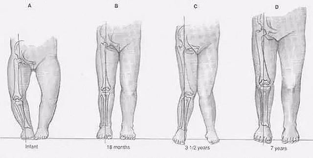 孩子发烧惊厥家长竟这样做?这些偏方真会害死