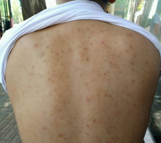 皮疹和湿疹的症状有什么不同,皮疹这样治疗才