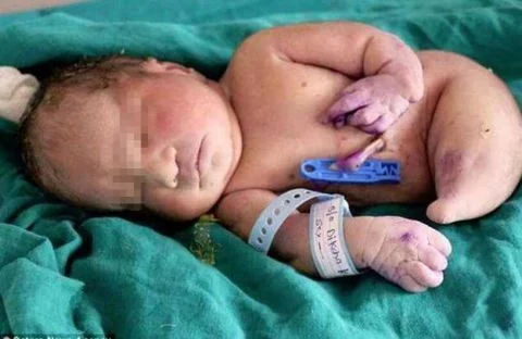 印度女子产下“美人鱼宝宝” 不幸的是小天使仅存活15分钟