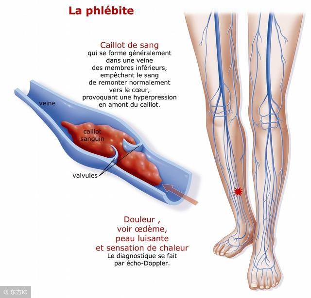 下肢深静脉血栓诊疗