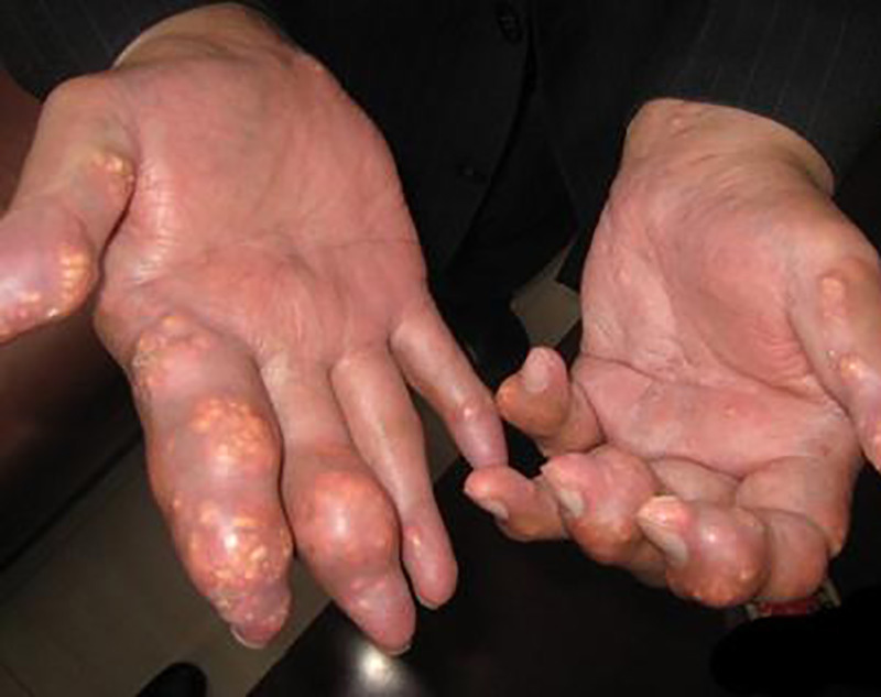 秋天痛风发作难忍,1种"白菜"是高尿酸克星,煎水喝7天见效!