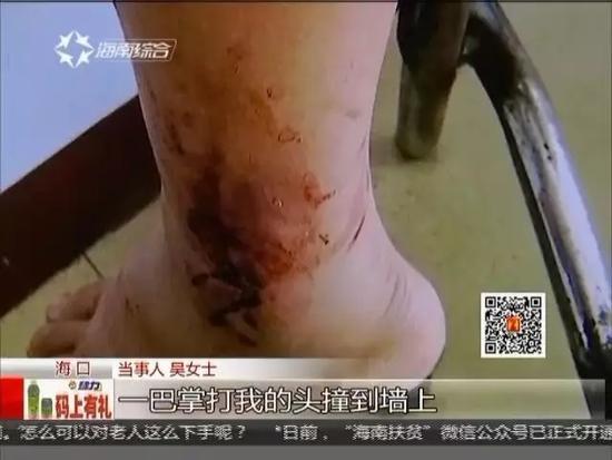 女子被三男子幽禁5小时 遭轮流殴打腿被砍断 女子被三男子幽禁5小时 遭轮流殴打腿被砍断