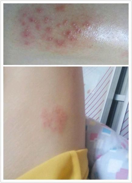 手上起了水泡型湿疹不要怕!这3招可以让你快速治愈不复发!