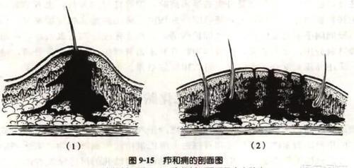 为什么有时候古人背上长了一个疮就死了?原