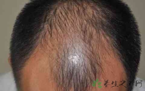 秋季皮膚起癬怎麼辦 雪花新闻 秋季皮膚起癬怎麼辦 雪花新闻