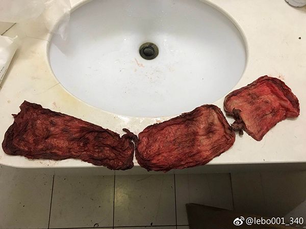 产妇剖腹产3天后排出纱布 北大人民医院:工作