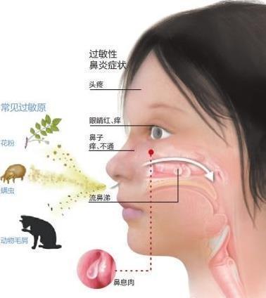 慢性过敏性鼻炎 中医治疗方法