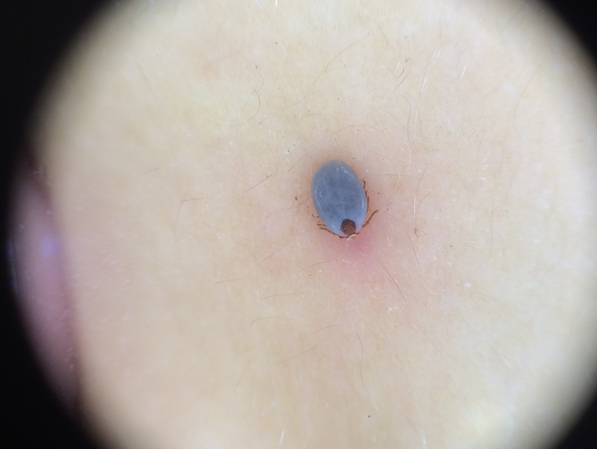 皮肤镜下的蜱虫(北京清华长庚医院皮肤科供图)