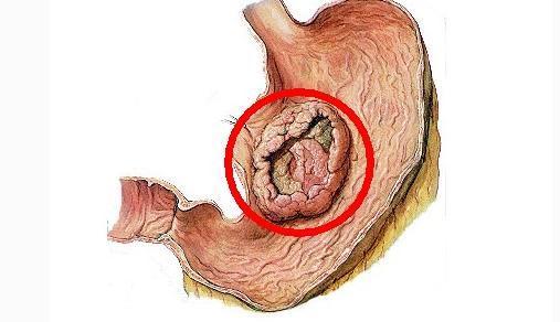 胃癌晚期扩散图片图片