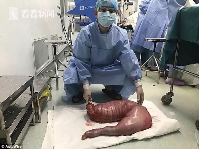 小伙子生来就便秘 手术拿掉25斤"粪便"
