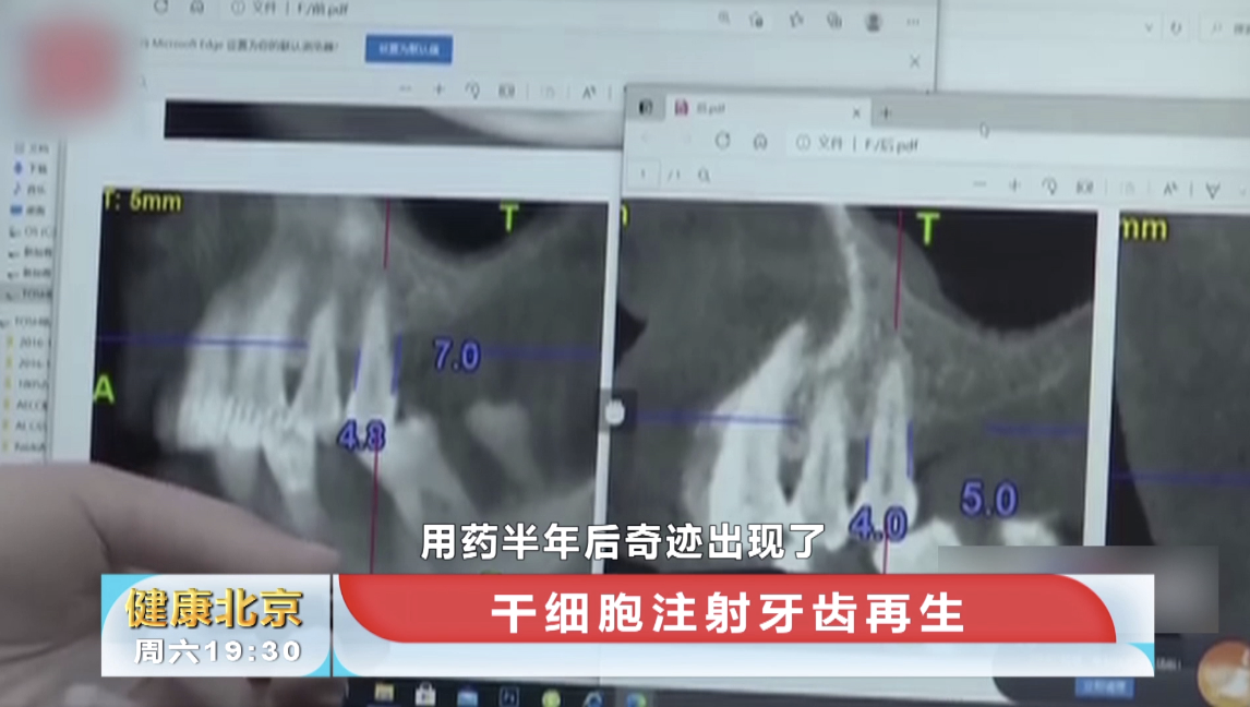 牙齿再生不是梦！女患者报名干细胞再生技术，长出两毫米牙槽骨