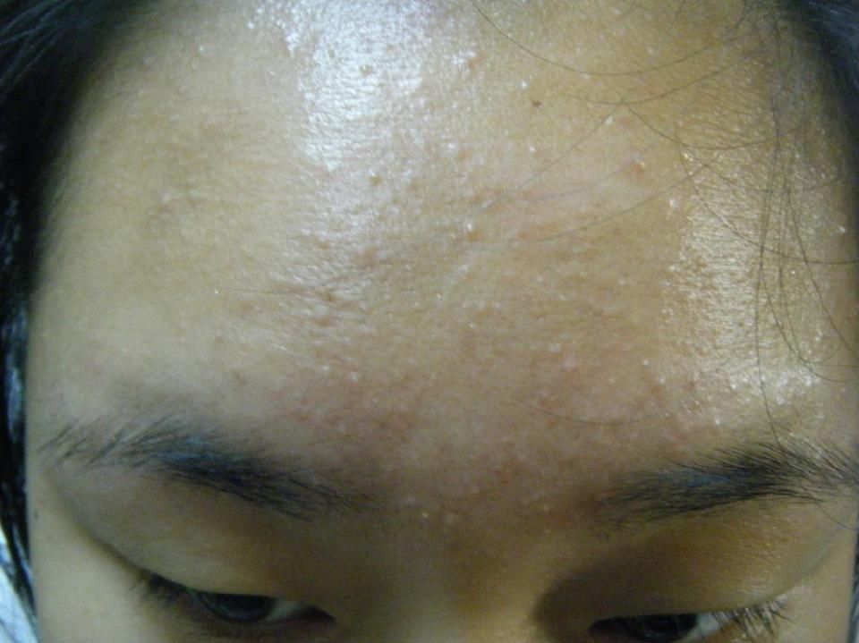 脸长粉刺惹人烦,3招还你肌肤光滑细腻!