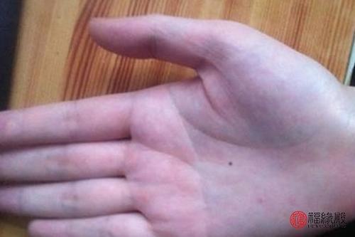 女性右手手心突然长痣