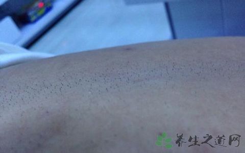 毛囊炎用皮炎平可以吗