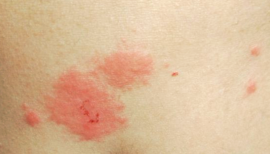 大腿内侧长红疙瘩很痒怎么办?摆脱只需一招