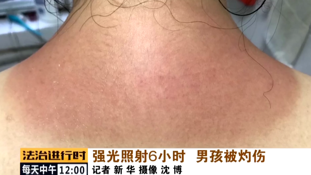 男孩学钢琴被时被紫外线灯灼伤!律师:学校应该承担责任