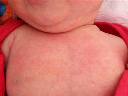 幼儿急疹出疹后几天消退,出疹后如何护理 幼儿急疹出疹后几天消退,出疹后如何护理