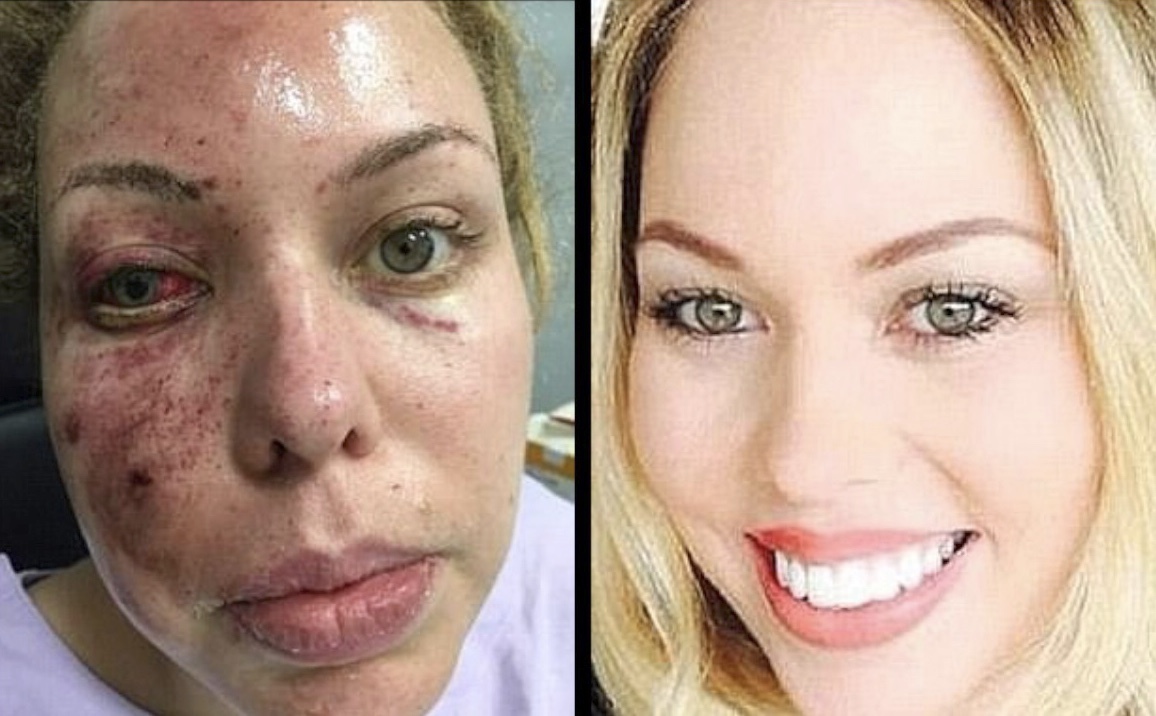 选错男友后果严重 选美皇后面部烧伤惨遭毁容