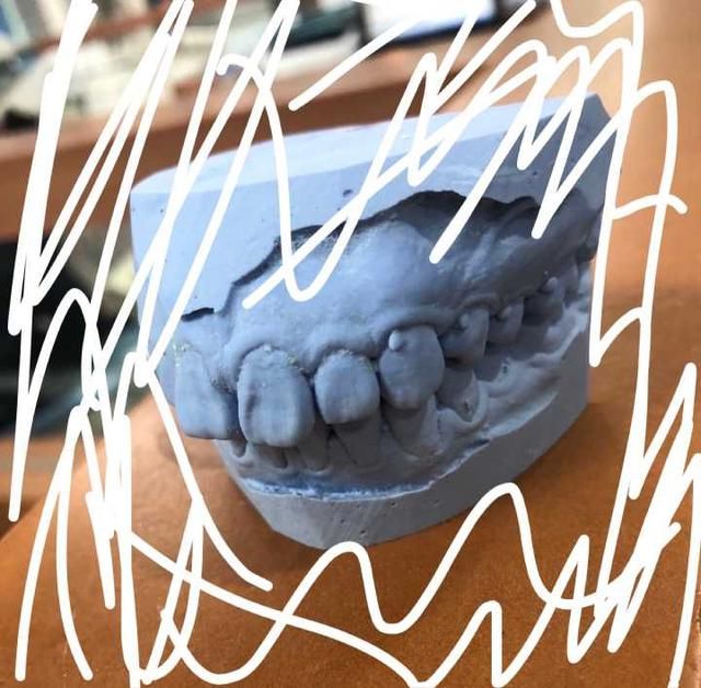 牙套小萌新的整牙日记:龅牙,短下巴,拔四颗牙