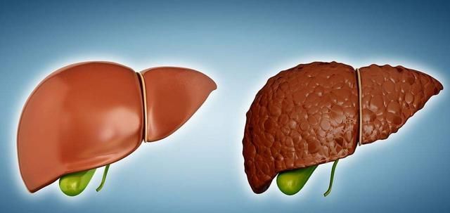 男子肝硬化,中医专家这样开药,现在彩超复查无