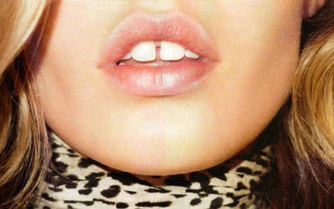 牙缝变大是由哪些原因造成的?怎么修复?