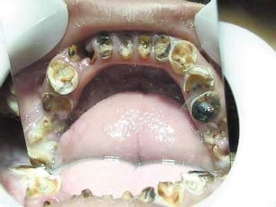 人从蛀牙到牙齿被腐蚀到底经历过怎样触目惊心