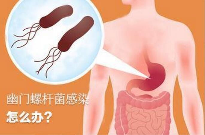 对抗益生菌,它能抑制引发胃病的幽门螺旋杆菌