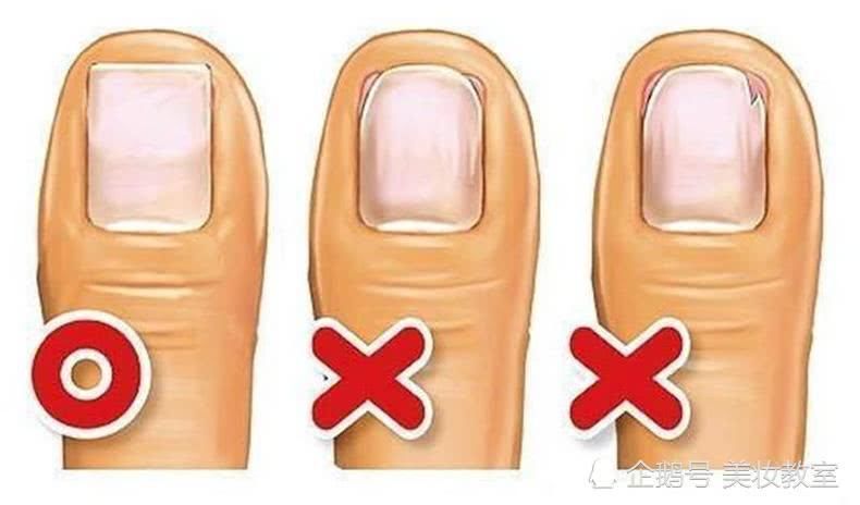 脚趾甲长肉里不能穿高跟鞋?这一招就搞定!