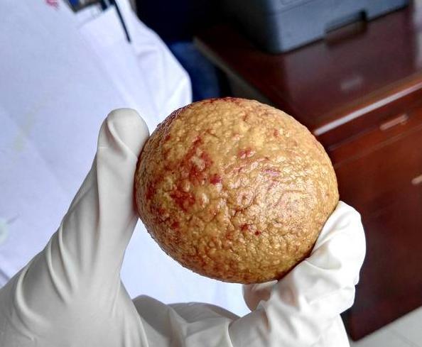 印度男子腹痛入院,膀胱取出1.5公斤巨型结石