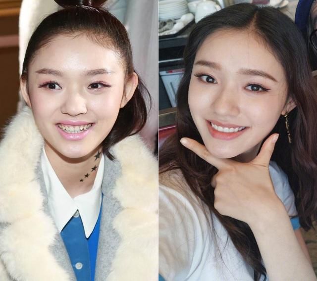 明星整牙堪比整容,杨幂秒变小V脸,baby只是摘