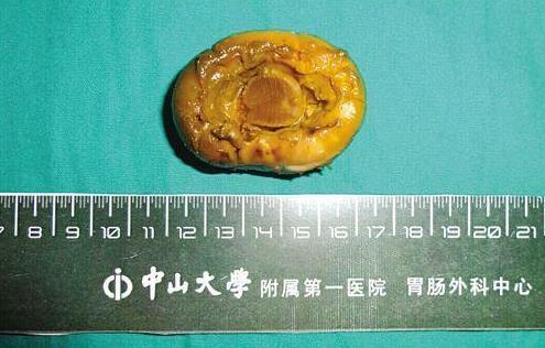 老伯未戴假牙进食不慎香菇滑落肚 花6万取出 老伯未戴假牙进食不慎香菇滑落肚 花6万取出