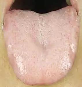 患癌时的舌头是什么样的?快自查