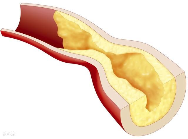 有人说动脉粥样硬化可以逆转,斑块也能消除,如何才能做到?