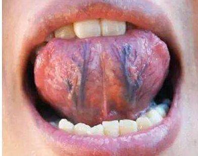 舌头下面有青筋,是身体出现异常?多数人或许