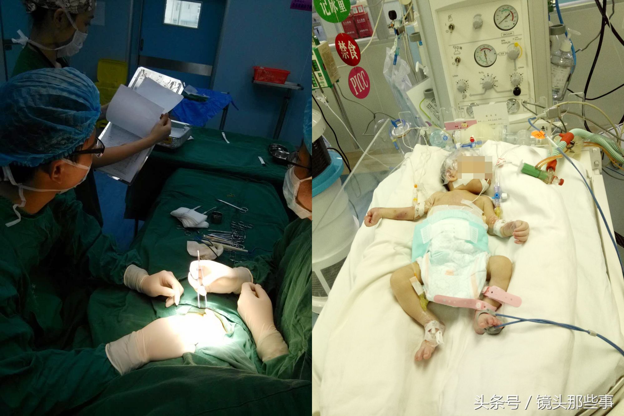 出生4天的早产宝宝胃穿孔 腹胀如包子 让人心疼!
