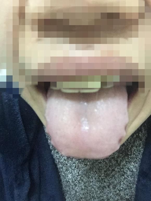 珍贵舌诊:气血不足、脾肾阳虚、肝郁血虚的舌