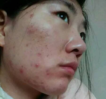 怎么用芦荟祛痘,5毛钱的便宜又实惠,祛痘还杠