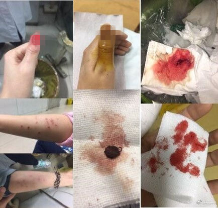 女大学生称遭舍友欺辱胸部受伤 同学:两人曾是闺蜜 女大学生称遭舍友欺辱胸部受伤 同学:两人曾是闺蜜