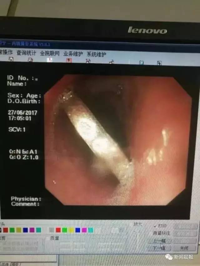 喉咙卡东西图片图片